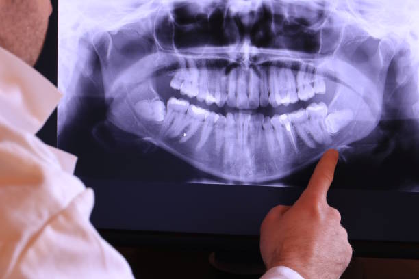 Best Emergency Root Canal Treatment in Sequim, WA